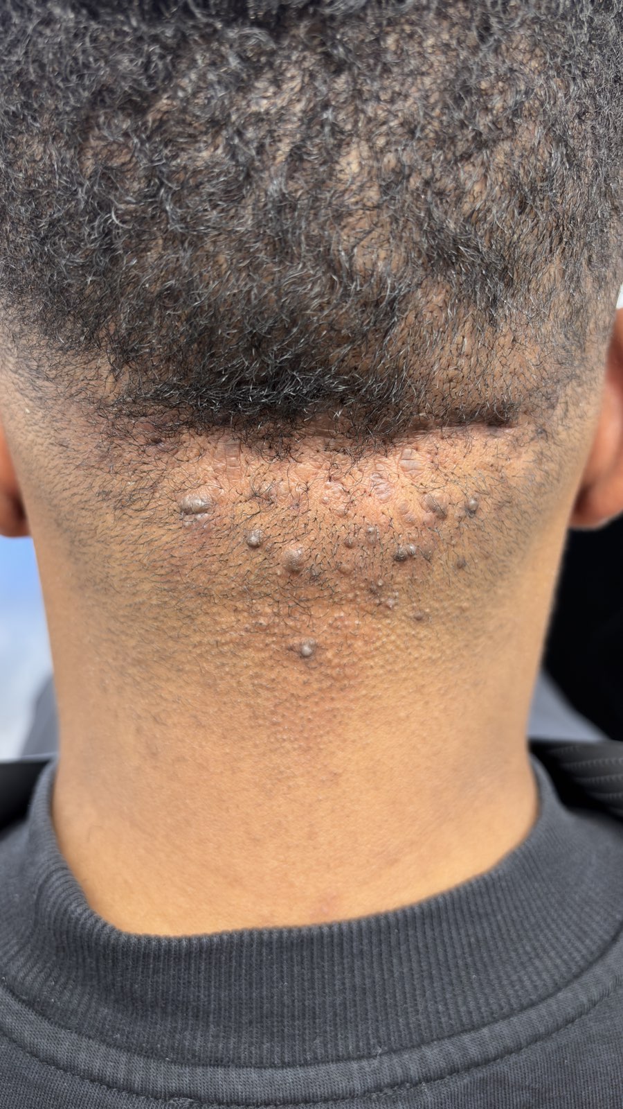 Raised papules along the neckline and lower scalp, an earlier presentation of Acne Keloidalis Nuchae