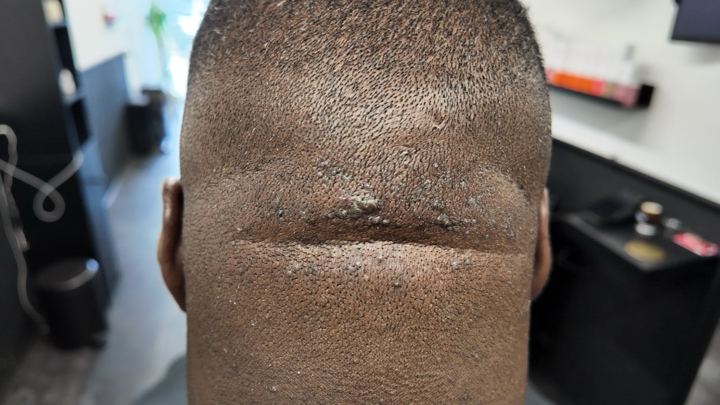 A raised band of thickened keloid-like scar tissue across the nape, more established Acne Keloidalis Nuchae